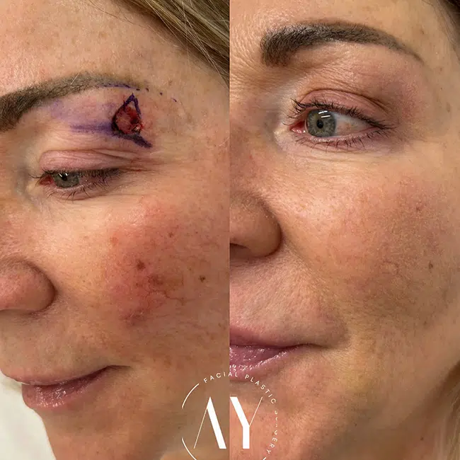 Before & After Photos Alisa Yamasaki, MD