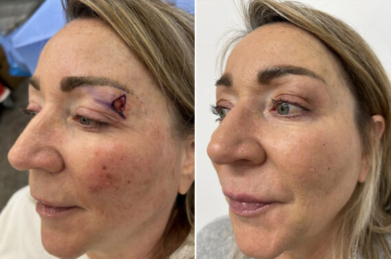 Mohs Reconstruction Before and After Photos in Princeton, NJ, Patient 9669