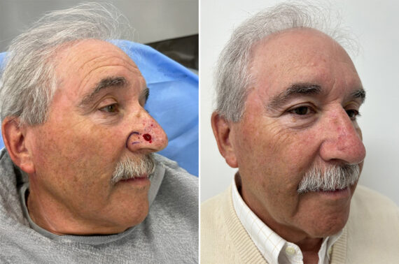 Mohs Reconstruction Before and After Photos in Princeton, NJ, Patient 9673