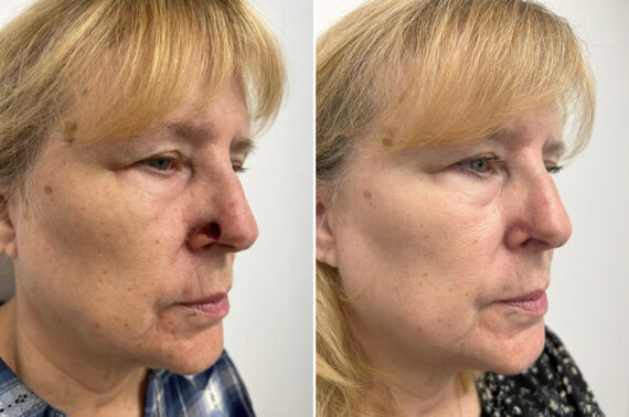 Mohs Reconstruction Before and After Photos in Princeton, NJ, Patient 9677