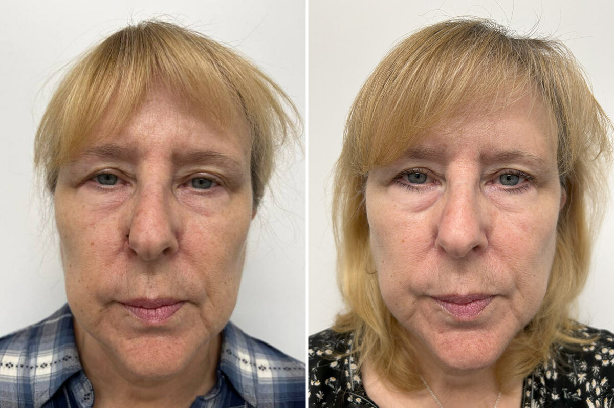 Mohs Reconstruction Before and After Photos in Princeton, NJ, Patient 9677