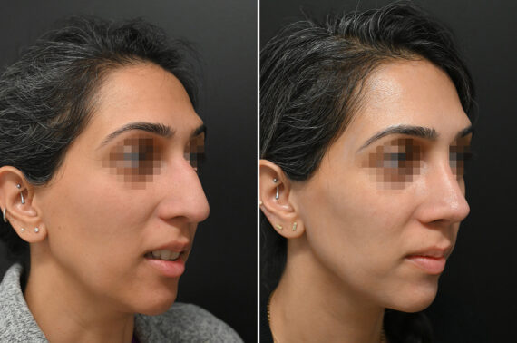 Rhinoplasty Before and After Photos in Princeton, NJ, Patient 9684