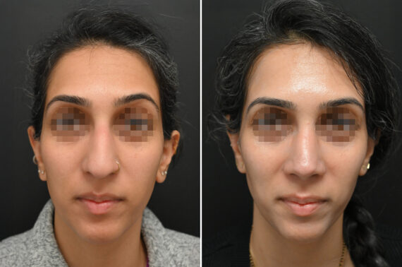 Rhinoplasty Before and After Photos in Princeton, NJ, Patient 9684