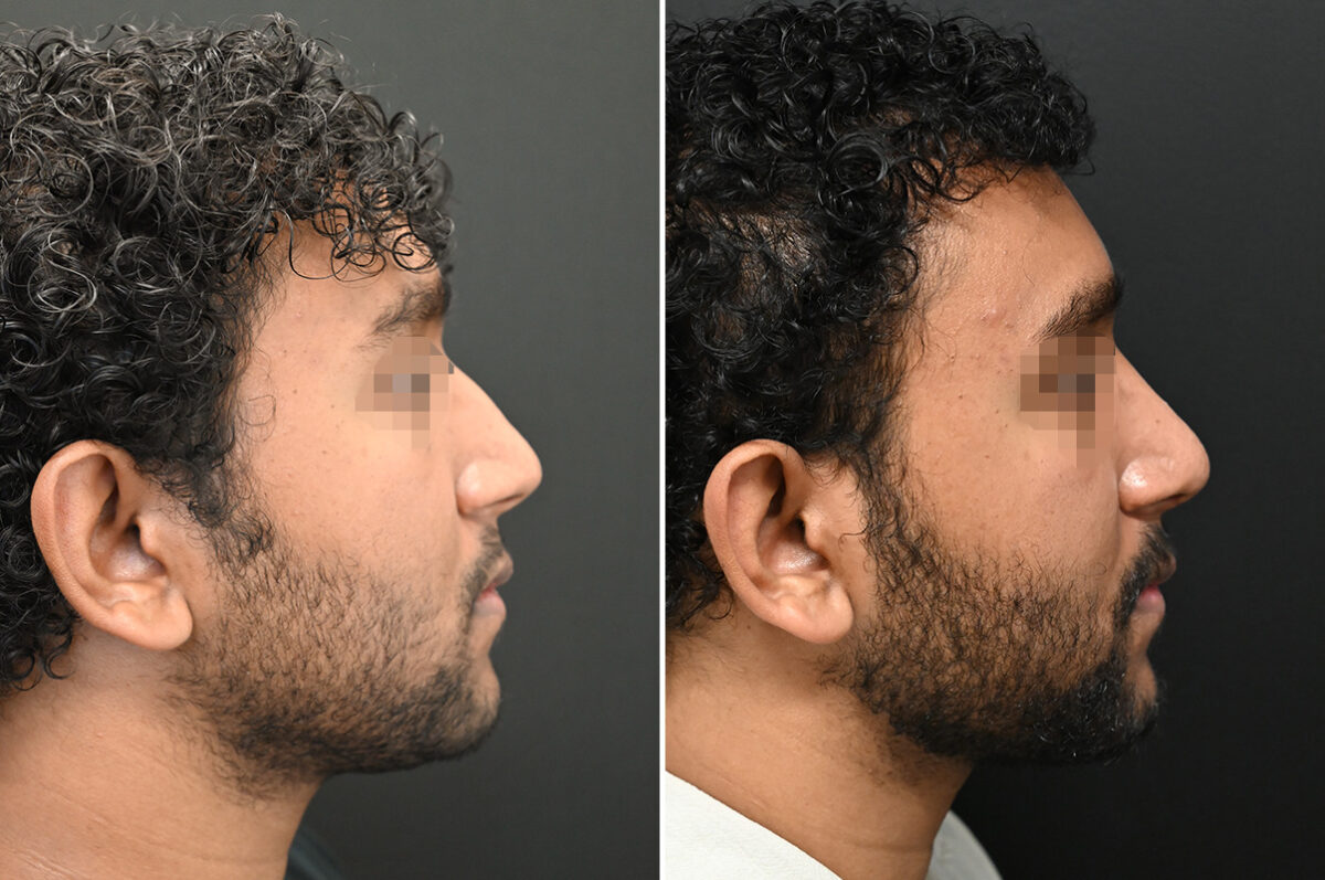 Rhinoplasty Before and After Photos in Princeton, NJ, Patient 9700