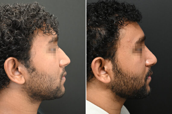 Rhinoplasty Before and After Photos in Princeton, NJ, Patient 9700