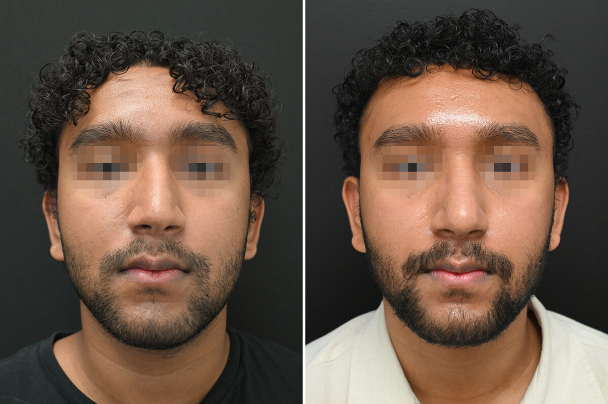 Rhinoplasty Before and After Photos in Princeton, NJ, Patient 9700