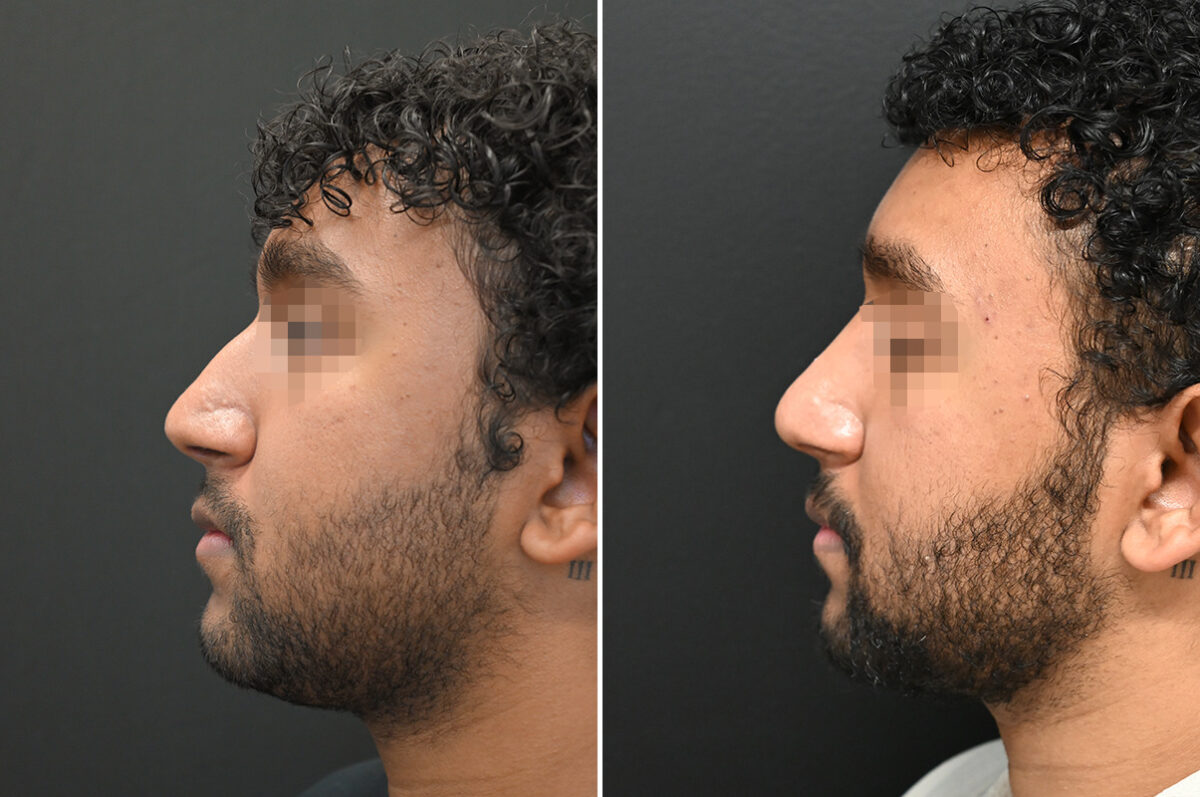 Rhinoplasty Before and After Photos in Princeton, NJ, Patient 9700