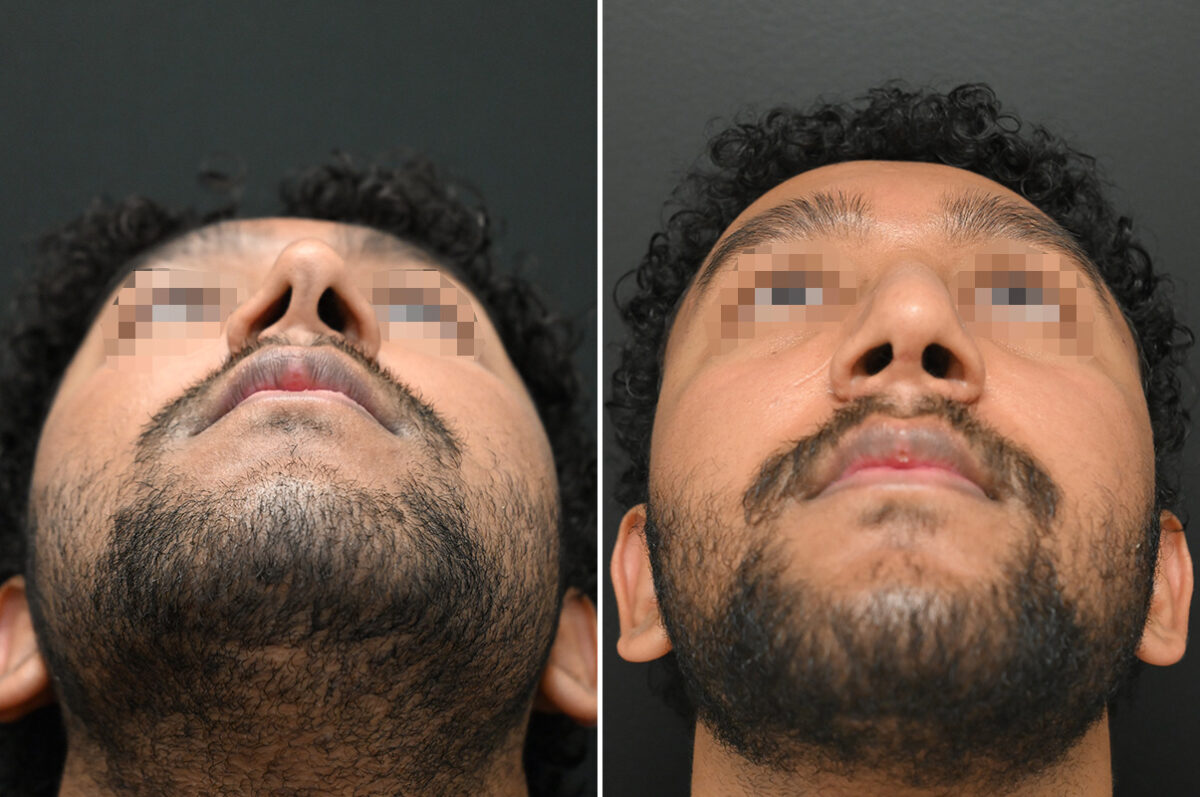 Rhinoplasty Before and After Photos in Princeton, NJ, Patient 9700