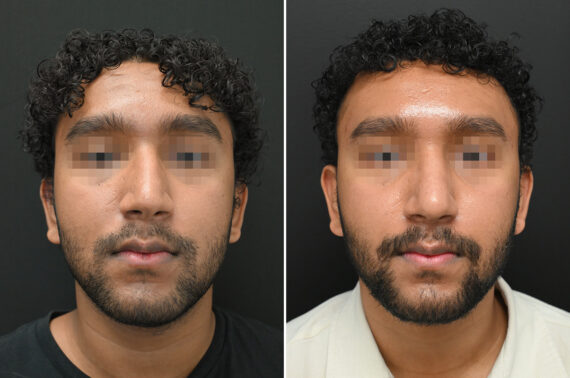 Rhinoplasty Before and After Photos in Princeton, NJ, Patient 9700