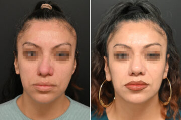 Revision Rhinoplasty Before and After Photos in Princeton, NJ, Patient 9713