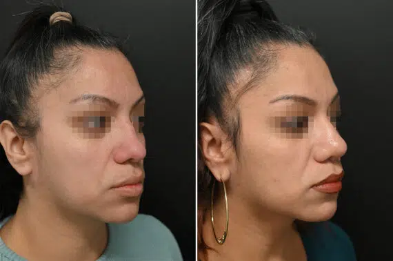 Revision Rhinoplasty Before and After Photos in Princeton, NJ, Patient 9713