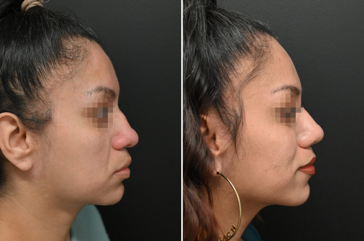 Revision Rhinoplasty Before and After Photos in Princeton, NJ, Patient 9713