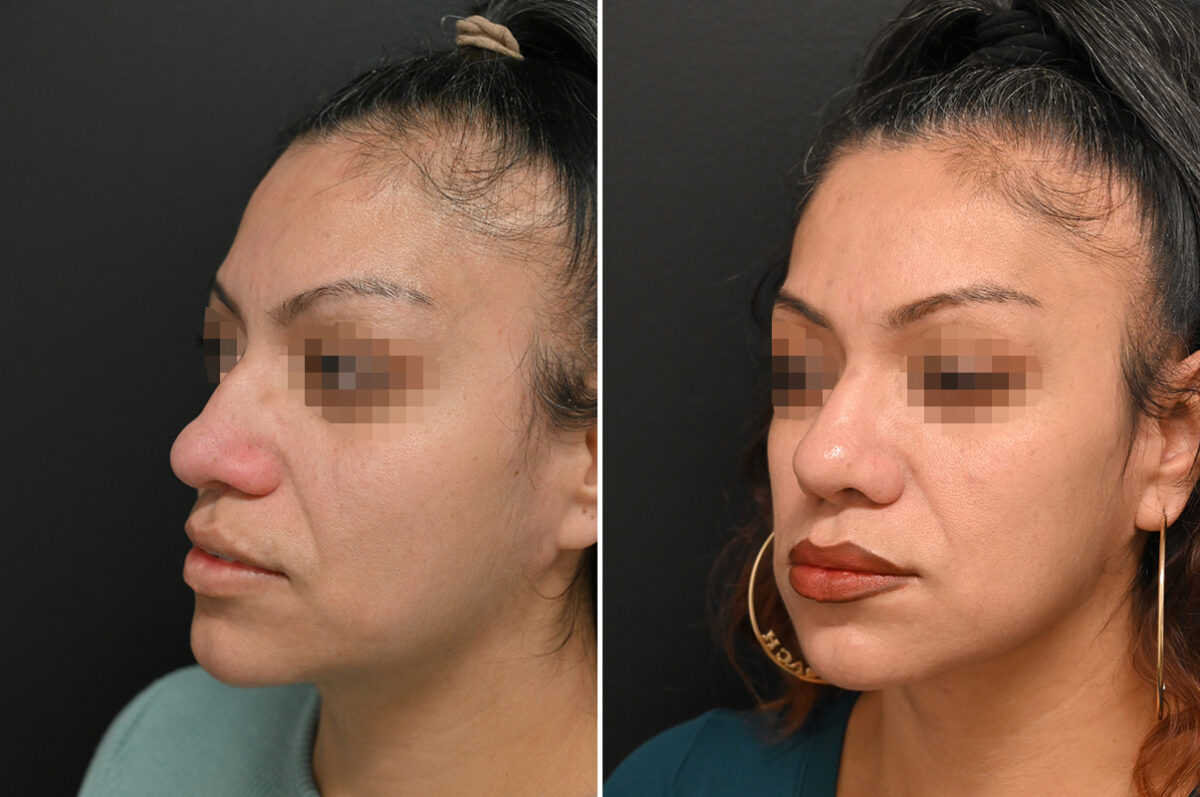 Revision Rhinoplasty Before and After Photos in Princeton, NJ, Patient 9713