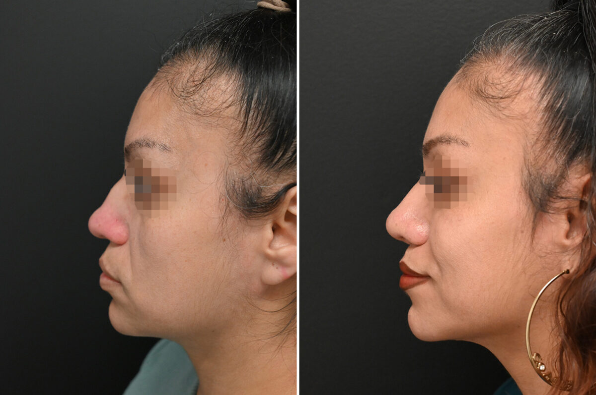 Revision Rhinoplasty Before and After Photos in Princeton, NJ, Patient 9713
