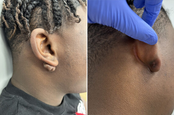 Scar Revision Before and After Photos in Princeton, NJ, Patient 9729