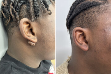 Scar Revision Before and After Photos in Princeton, NJ, Patient 9729