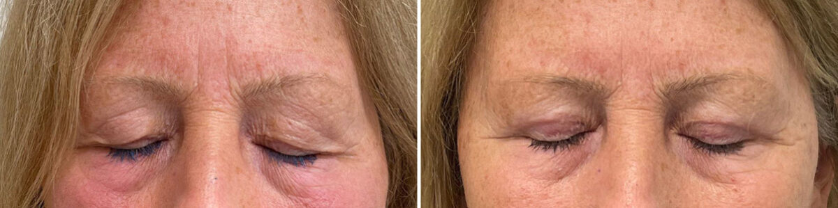 Blepharoplasty Before and After Photos in Philadelphia, PA, Patient 10660