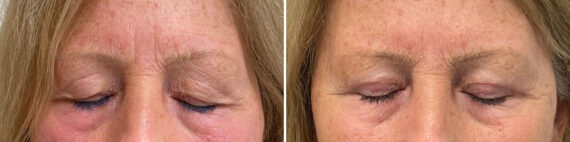 Blepharoplasty Before and After Photos in Philadelphia, PA, Patient 10660
