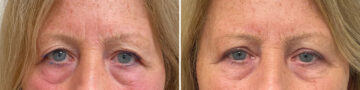 Blepharoplasty Before and After Photos in Philadelphia, PA, Patient 10660