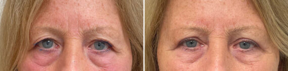 Blepharoplasty Before and After Photos in Philadelphia, PA, Patient 10660