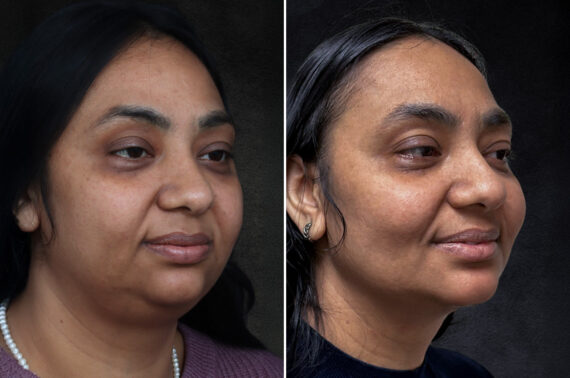 Buccal Fat Removal Before and After Photos in Philadelphia, PA, Patient 10667