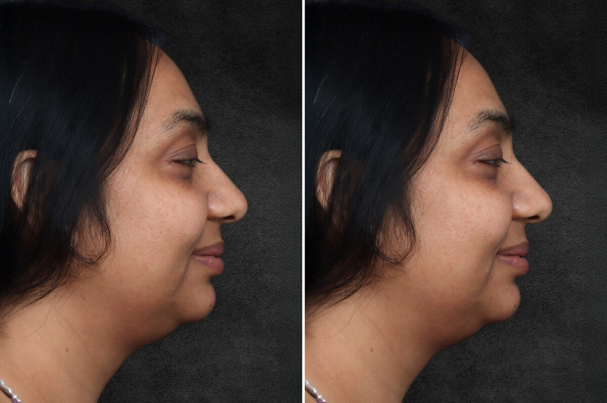 Buccal Fat Removal Before and After Photos in Philadelphia, PA, Patient 10667