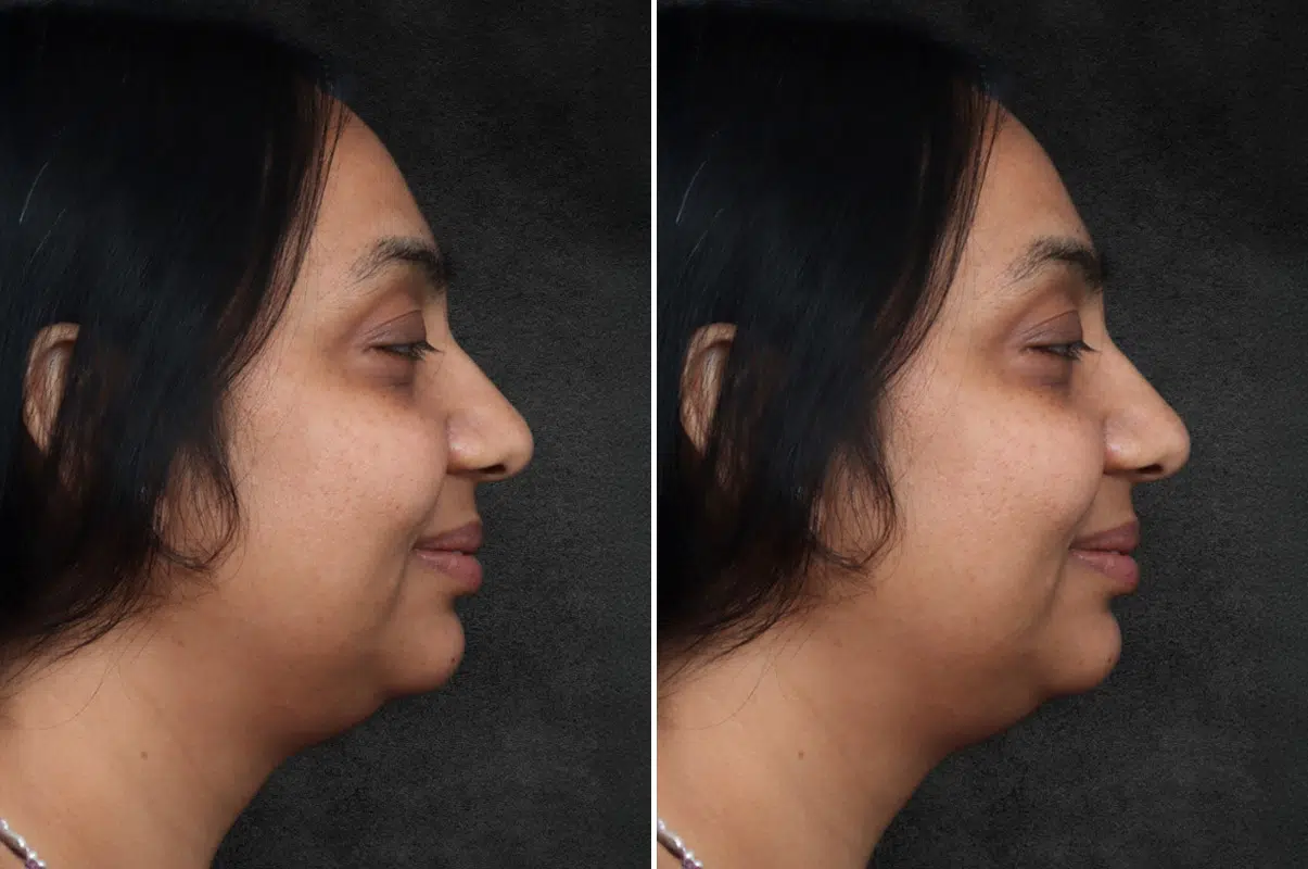 patient-10667-neck-lift-before-after