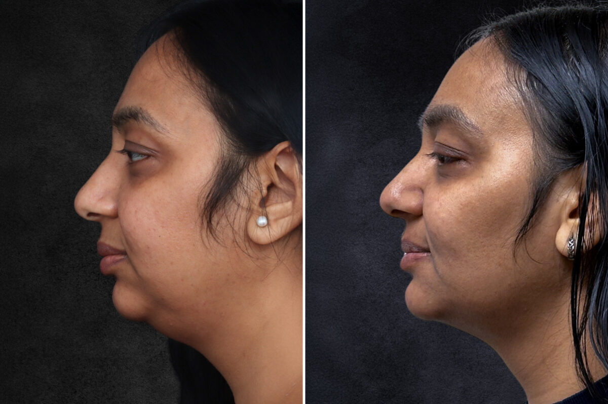 Buccal Fat Removal Before and After Photos in Philadelphia, PA, Patient 10667