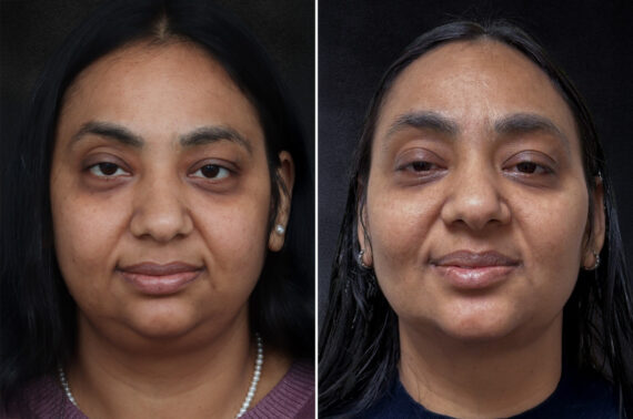 Buccal Fat Removal Before and After Photos in Philadelphia, PA, Patient 10667