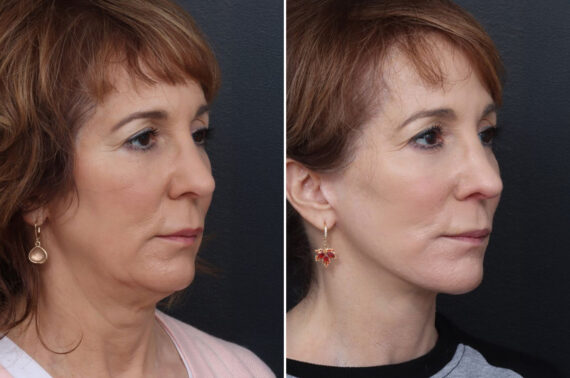 Chin Implants Before and After Photos in Philadelphia, PA, Patient 10680