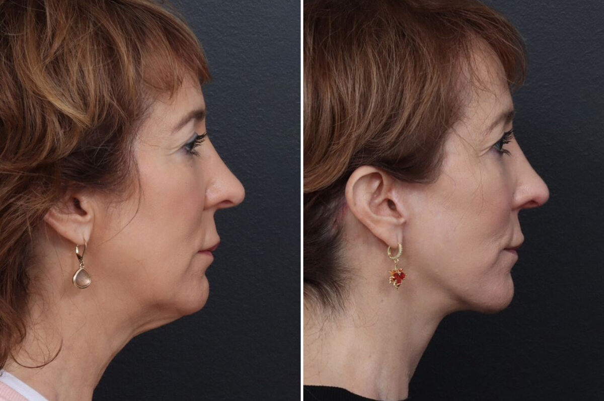 Chin Implants Before and After Photos in Philadelphia, PA, Patient 10680
