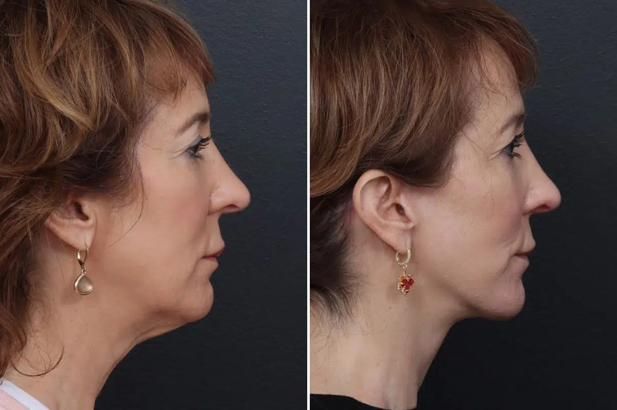 patient-10680-facelift-before-after