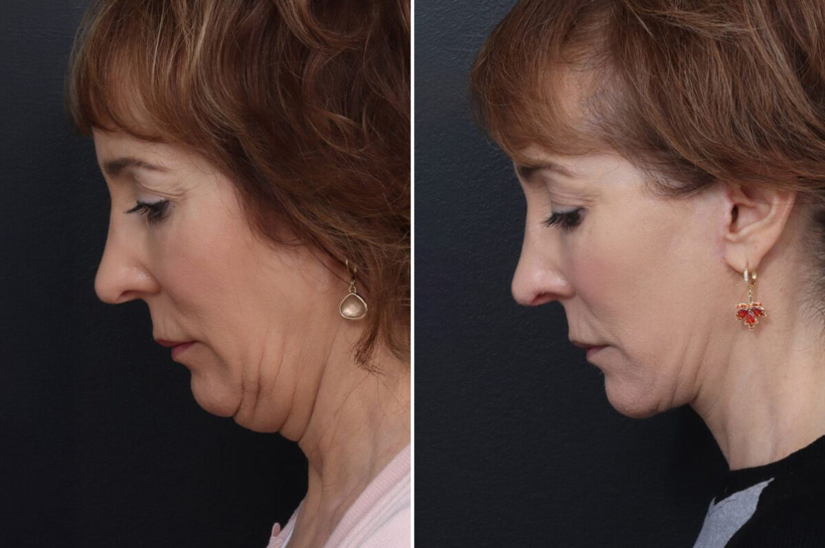 Chin Implants Before and After Photos in Philadelphia, PA, Patient 10680