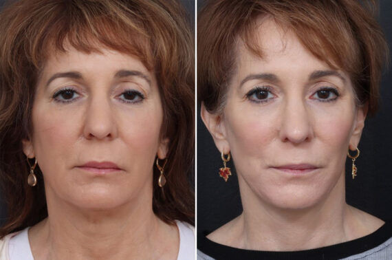Chin Implants Before and After Photos in Philadelphia, PA, Patient 10680
