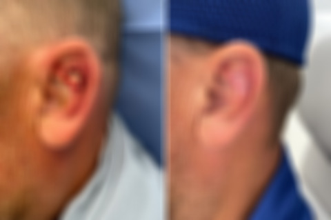 Reconstructive Surgery Before and After Photos in Philadelphia, PA, Patient 10696