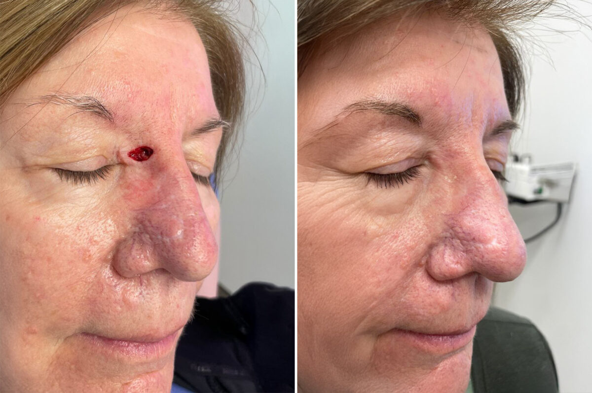 Reconstructive Surgery Before and After Photos in Philadelphia, PA, Patient 10704