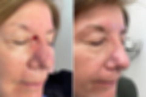 Reconstructive Surgery Before and After Photos in Philadelphia, PA, Patient 10704