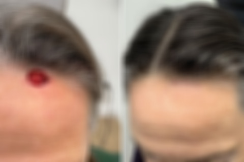 Reconstructive Surgery Before and After Photos in Philadelphia, PA, Patient 10708