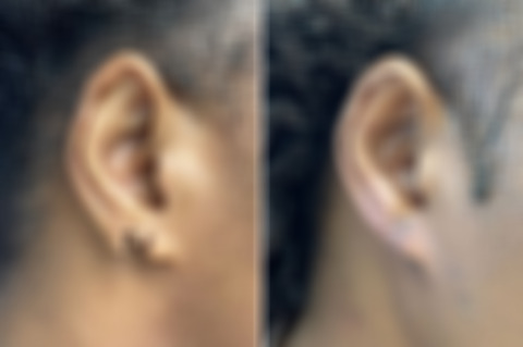 Reconstructive Surgery Before and After Photos in Philadelphia, PA, Patient 10730