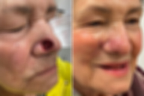 Reconstructive Surgery Before and After Photos in Philadelphia, PA, Patient 10747