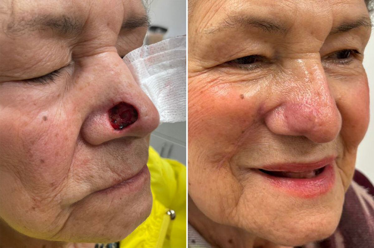 Reconstructive Surgery Before and After Photos in Philadelphia, PA, Patient 10747