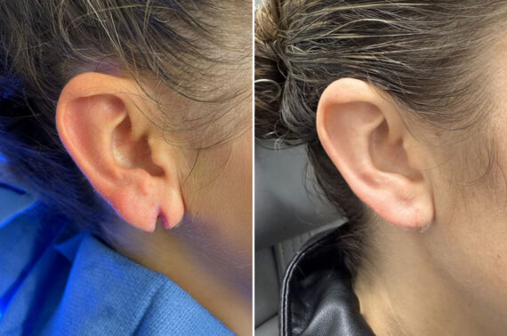 Reconstructive Surgery Before and After Photos in Philadelphia, PA, Patient 10754