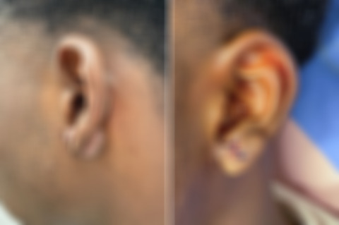 Reconstructive Surgery Before and After Photos in Philadelphia, PA, Patient 10758