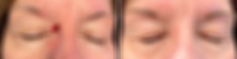 Reconstructive Surgery Before and After Photos in Philadelphia, PA, Patient 10762