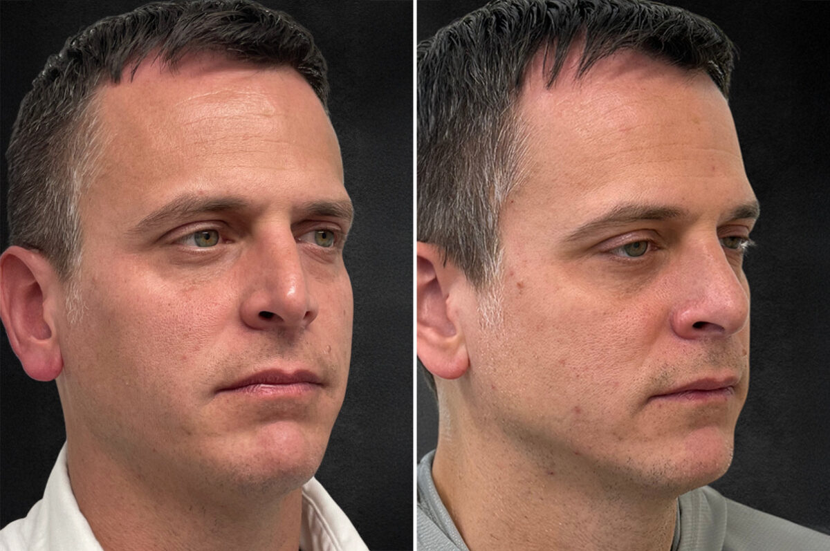 Rhinoplasty Before and After Photos in Philadelphia, PA, Patient 10774