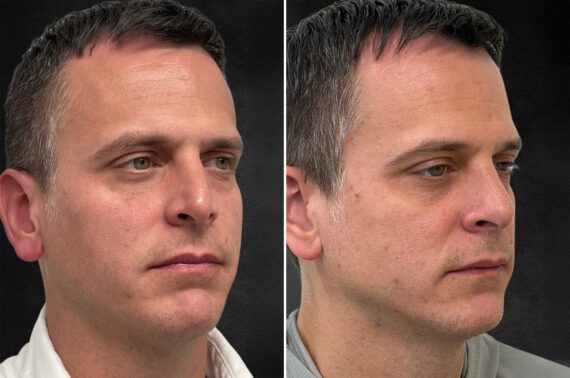 Rhinoplasty Before and After Photos in Philadelphia, PA, Patient 10774