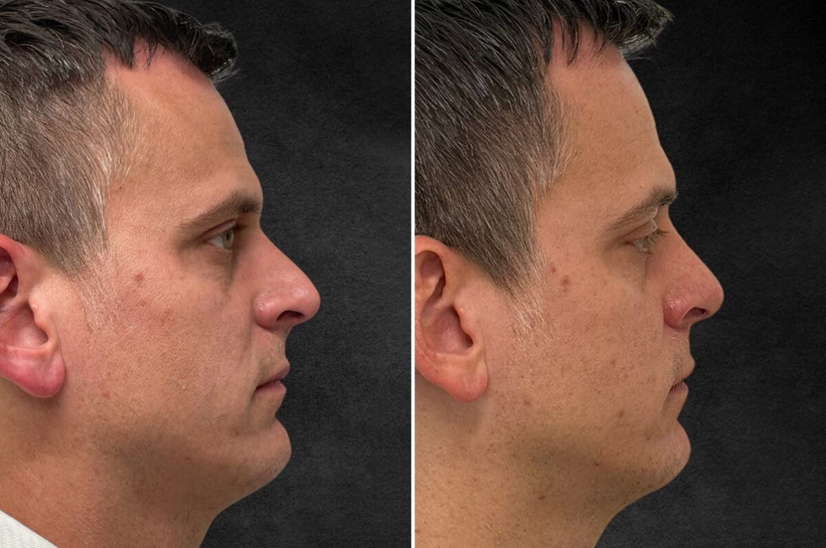 Rhinoplasty Before and After Photos in Philadelphia, PA, Patient 10774