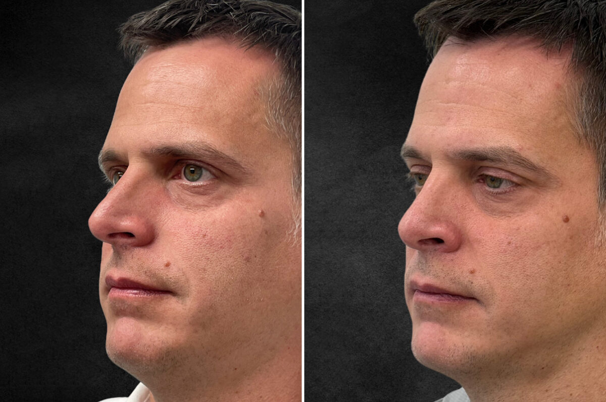 Rhinoplasty Before and After Photos in Philadelphia, PA, Patient 10774