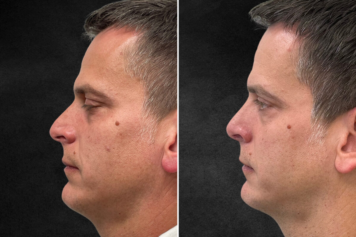 Rhinoplasty Before and After Photos in Philadelphia, PA, Patient 10774