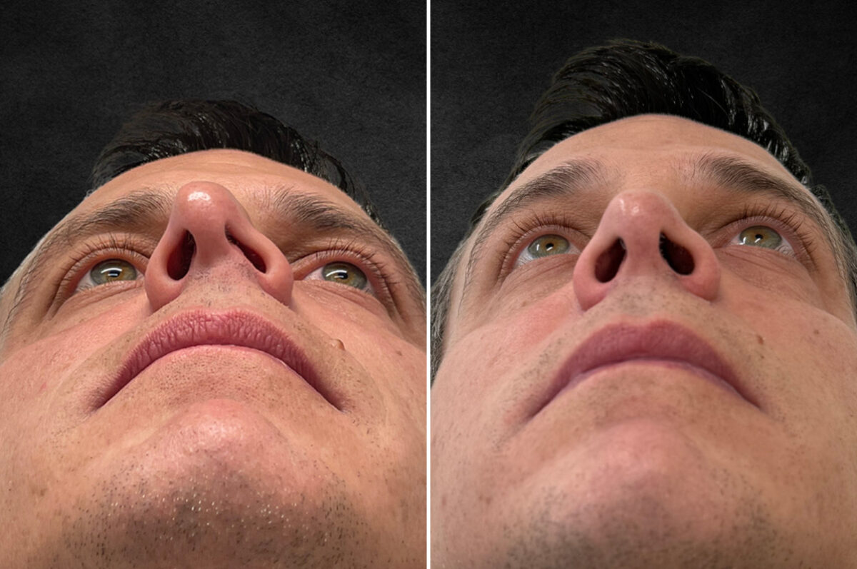 Rhinoplasty Before and After Photos in Philadelphia, PA, Patient 10774